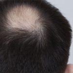 Why Are You Losing Hair?