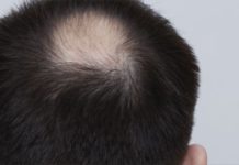 Why Are You Losing Hair?