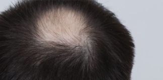 Why Are You Losing Hair?